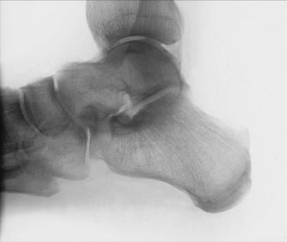 Fig. 6.77 Mediolateral Calcaneu.