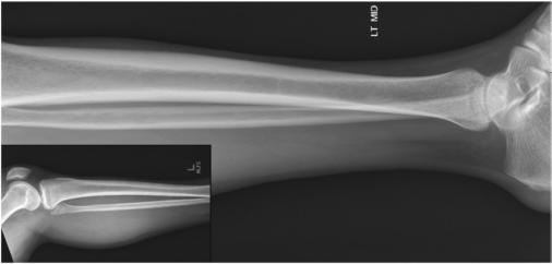 Fig. 6.102 Mediolateral Gambă incidență. Inset shows proximal