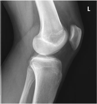 Fig. 6.113 Mediolateral Genunchi. (Courtesy Joss Wertz, DO.)