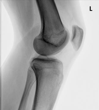 Fig. 6.114 Mediolateral Genunchi. (Courtesy Joss Wertz, DO.)