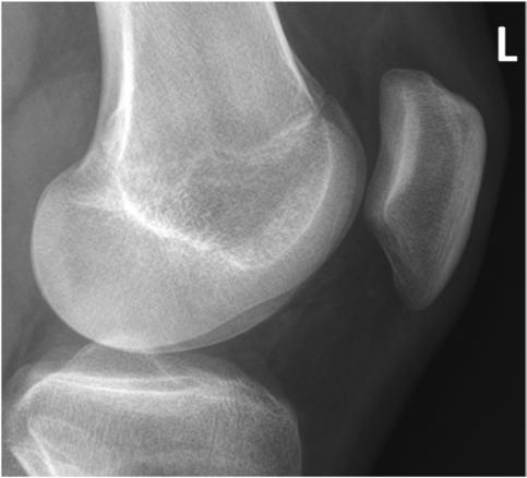 Fig. 6.133 lateral Rotulă (Patelă). (Courtesy Joss Wertz, DO.)