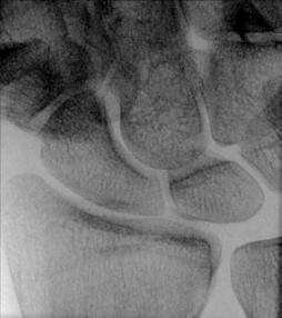 Fig. 4.103 Severe pain ca follows: Mână ridicat 20°; fără ulnar