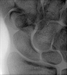 Fig. 4.104 Mână ridicat, ulnar