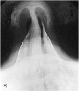 Fig. 11.141 Incidență tangențială superoinferioară (axială).