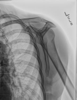 Fig. 5.105 lateral pentru acromion sau proces coracoid (approximately