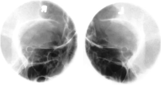 Fig. 11.153 bilateral parieto-