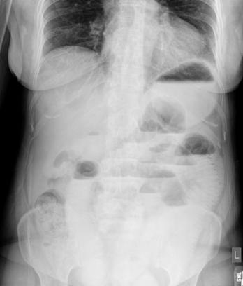 Fig. 3.40 AP în ortostatism—pentru a include cupolele diafragmatice. Ocluzia intestinală (nivele hidroaerice) este