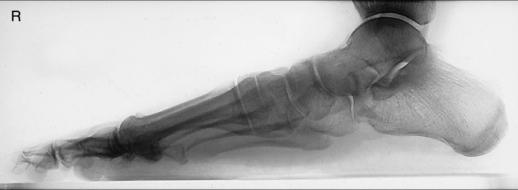 Fig. 6.69 lateral weight-