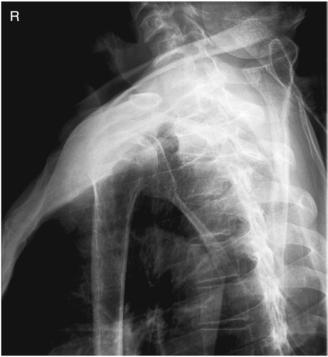 Fig. 5.75 Ortostatism transthoracic lateral.