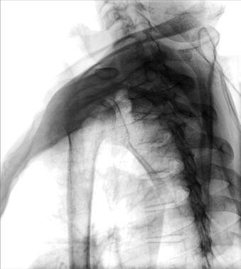 Fig. 5.76 Ortostatism transthoracic lateral.