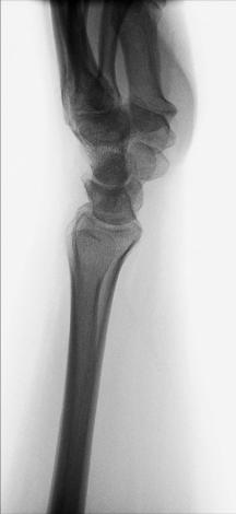 Fig. 4.96 Incidență de Profil (lateral)