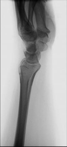 Fig. 4.97 lateral Pumn (Articulație Radiocarpiană).