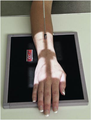 Fig. 4.86 PA Pumn (Articulație Radiocarpiană).