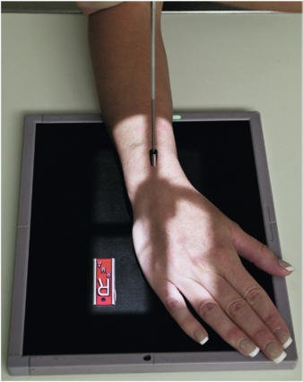 Fig. 4.108 PA Pumn (Articulație Radiocarpiană)—radial deviation.