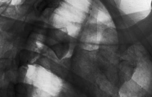 Fig. 10.32 10° la 15° RAO, drept articulații sternoclaviculare.