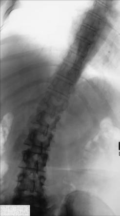Fig. 9.57 AP în decubit dorsal—înclinare spre dreapta. Inserție, PA în ortostatism—înclinare spre dreapta.