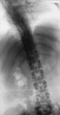 Fig. 9.59 AP—înclinare spre dreapta.