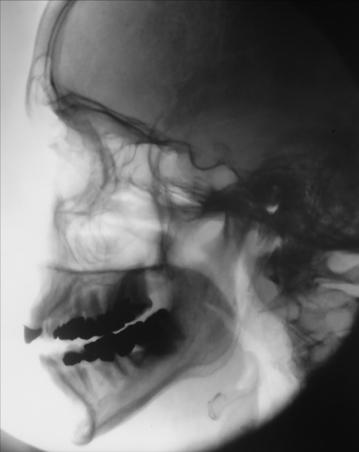 Fig. 11.128 profil masiv facial (oase ale feței).