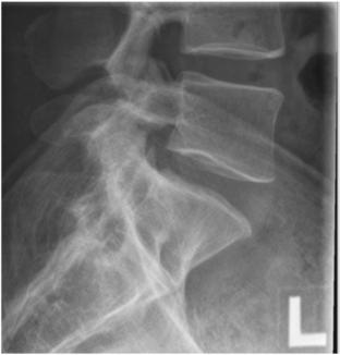 Fig. 9.41 laterală L5–S1.