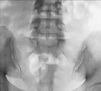 Fig. 9.44 AP axial L5–S1.