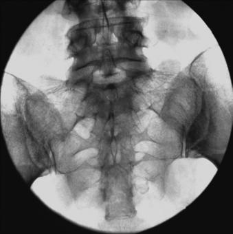 Fig. 9.74 AP axial de SI articulații.