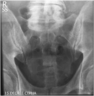 Fig. 9.65 AP axial—15° cranial.