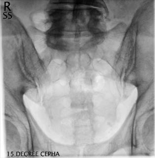 Fig. 9.64 AP axial—15° cranial.
