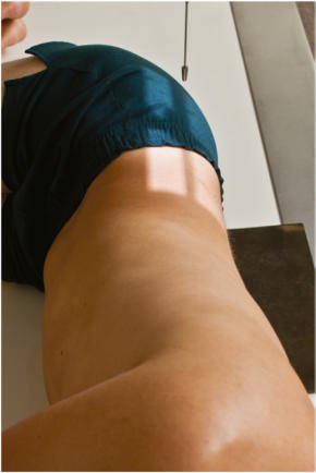 Fig. 9.69 sacru și coccis lateral.