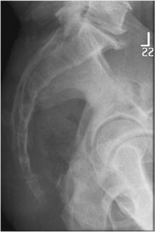 Fig. 9.70 sacru și coccis lateral.