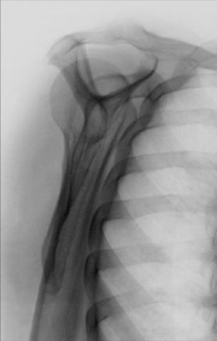 Fig. 5.78 PA oblic (scapular Y lateral) incidență.