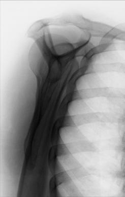 Fig. 5.79 PA oblic (scapular Y