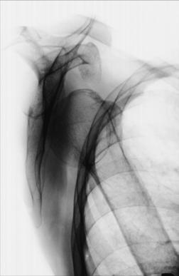 Fig. 5.80 PA oblic (scapular Y