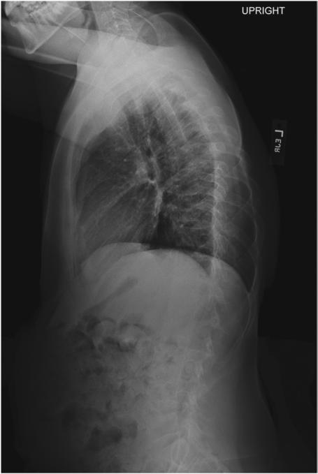 Fig. 9.49 Ortostatism lateral. Filtru compensatoriu toracic lateral Pb detașabil