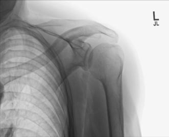 Fig. 5.62 Apical Incidență AP Axială.