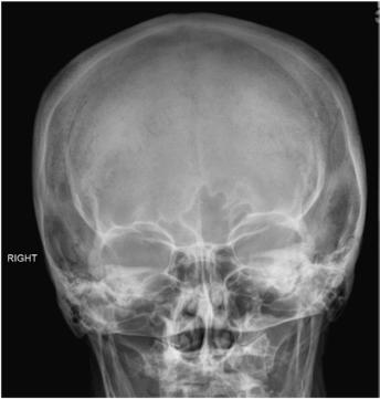 Fig. 11.190 Incidență postero-anterioară (PA)—sinusuri.