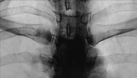Fig. 10.28 Articulații sternoclaviculare, PA bilateral.