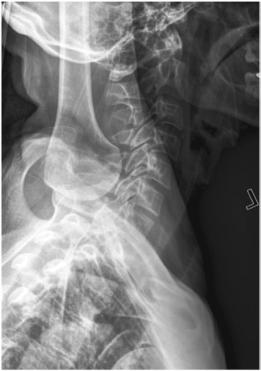 Fig. 8.64 Cervicotoracică