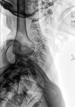 Fig. 8.62 Incidență laterală cervicotoracică (swimmer’s).