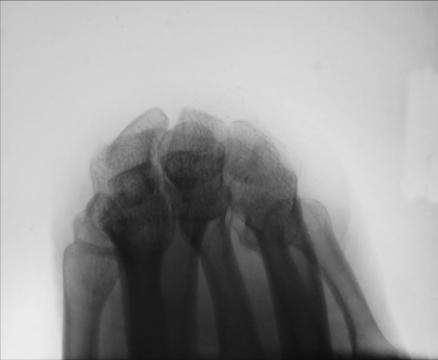 Fig. 4.116 Carpal bridge tangențial incidență de drept Pumn (Articulație Radiocarpiană).