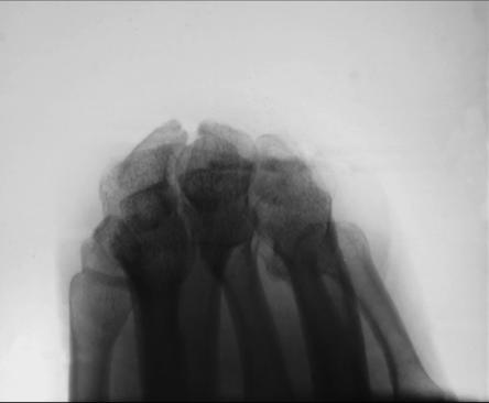 Fig. 4.117 Carpal bridge.