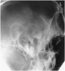 Fig. 11.185 gură deschisă (transorală).