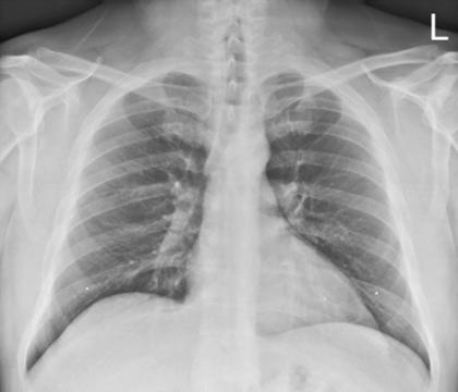 Fig. 2.66 AP semierect.