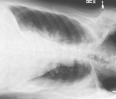 Fig. 2.68 Decubit lateral stâng (lichid vizibil în plămânul stâng).