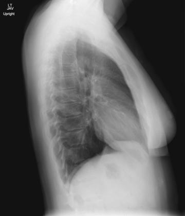 Fig. 2.59 stâng lateral Torace.
