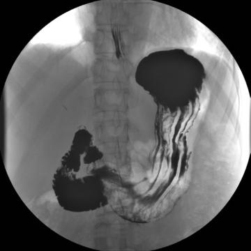 Fig. 12.103 AP Decubit dorsal. În imaginea inserată, varianta în poziție Trendelenburg.
