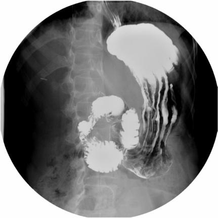 Fig. 12.102 poziție oblică posterioară stângă (OPS / LPO).