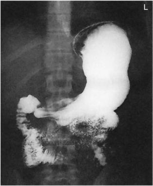 Fig. 12.97 Incidență Postero-Anterioară (PA).