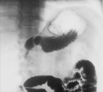 Fig. 12.94 Poziție RAO pentru tractul gastrointestinal superior.