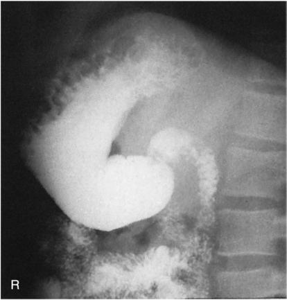 Fig. 12.100 Poziție de profil drept pentru tractul gastrointestinal superior.