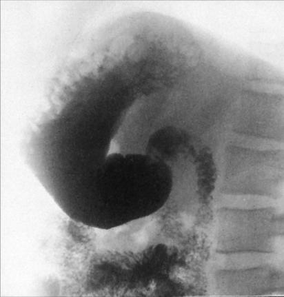 Fig. 12.99 Poziție de profil drept pentru tractul gastrointestinal superior.